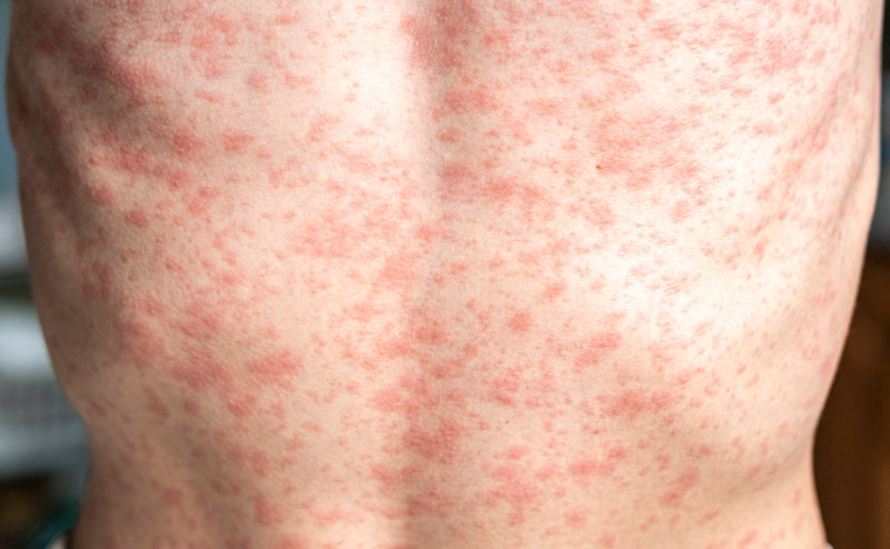 measles.jpg